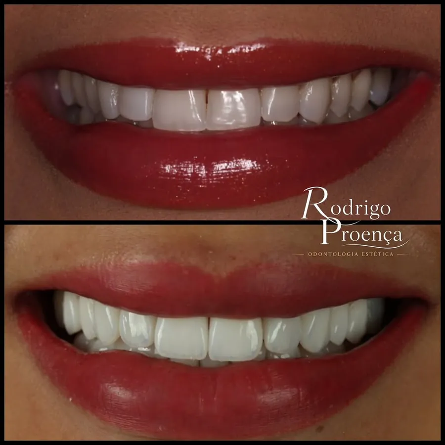 Antes e depois de tratamento com 21 lentes de contato dental